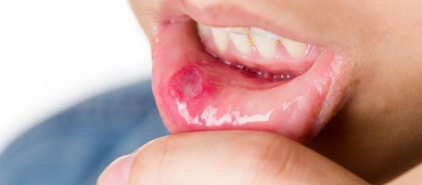 Άφθες στο στόμα: Με αυτό το λαχανικό θα τις εξαφανίσετε